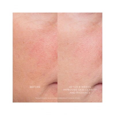 Equilibrium Resurfacing Retinoid Treatment